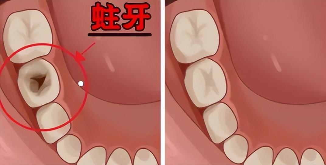 蛀牙最新研究，揭示预防与治疗的未来方向