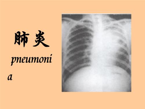 肺炎最新症状及其相关探讨